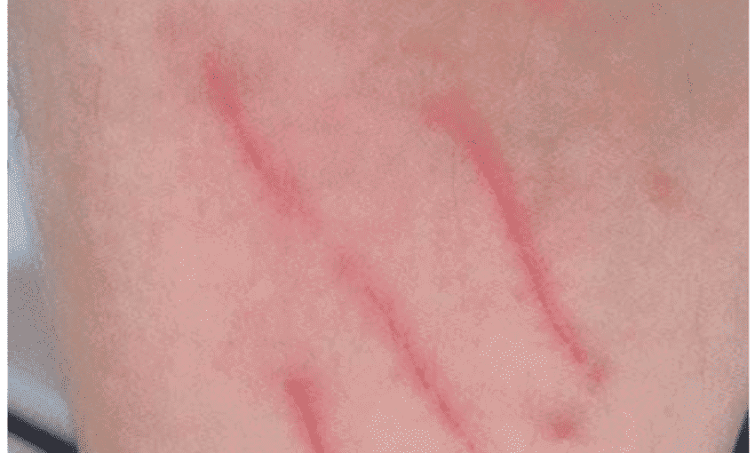 狗的抓痕特征是什么样的呢