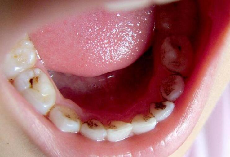 牙齿的虫子好恶心图片图片
